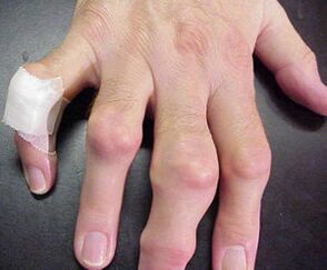 τα δάχτυλα με παραμορφώσεις των αρθρώσεων προκαλούν πόνο
