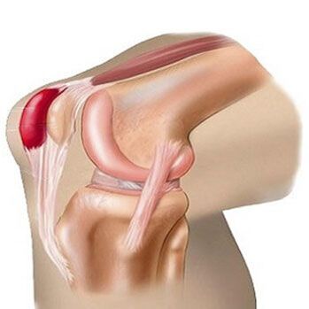 Μία από τις αιτίες του πόνου στην άρθρωση του γόνατος είναι η θυλακίτιδα. 